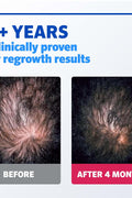 Rogaine Men's Extra Strength 5% Minoxidil Solution 3 Mo Supply, 3x 2 Fl Oz