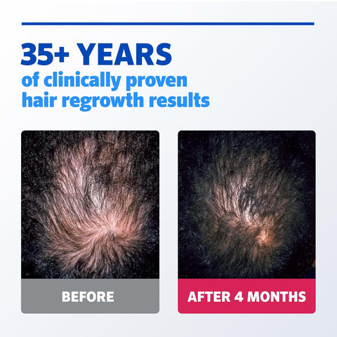 Rogaine Men's Extra Strength 5% Minoxidil Solution 3 Mo Supply, 3x 2 Fl Oz