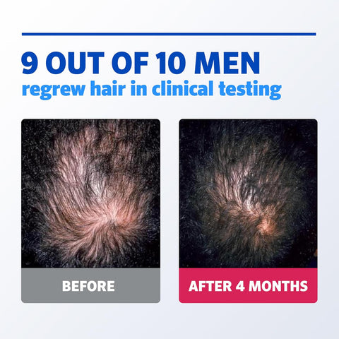 Rogaine Men's Rogaine 5% Minoxidil Foam for Hair Regrowth Topical Hair Loss Treatment for Men to Regrow Fuller Thicker Hair Unscented Minoxidil Topical Aerosol